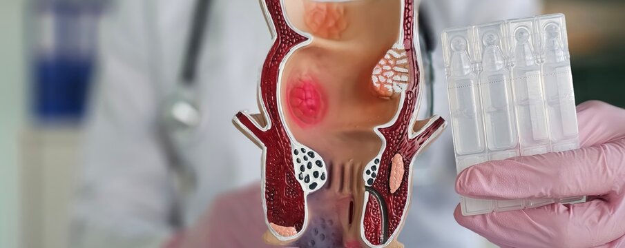 Experienced doctor holds probiotics and model of rectum in hands concept