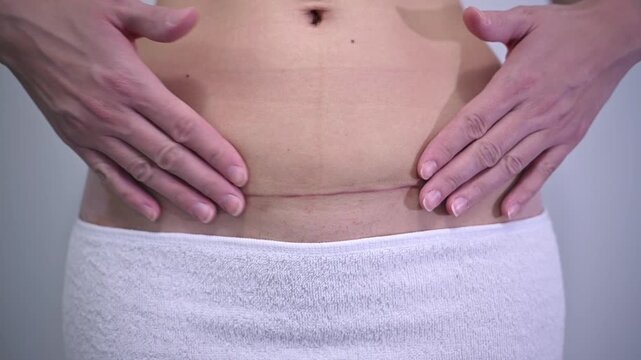 Close up view of a woman's hands touching her abdomen with a fresh scar from a caesarean section, showing the healing process and the skin recovery after childbirth and plastic surgery