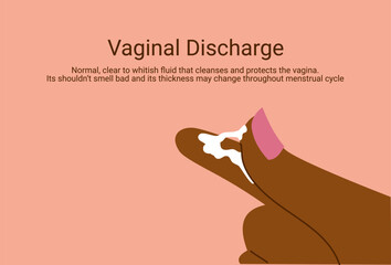 Vaginal discharge symptoms, medical concept of yeast infection, bacterial vaginosis and female reproductive health. Abnormal discharge vector illustration