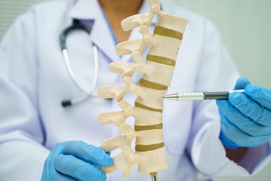 Asian doctor holding spinal nerve and bone model, Lumbar spine displaced herniated disc fragment for treatment medical in the orthopedic department.