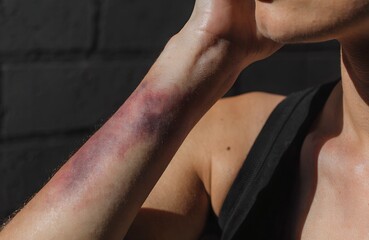 Bruised Skin Concept &ndash; Close-Up of Forearm with Purple and Red Discoloration Against Brick Wall Background, bruise, injury, trauma, skin, discoloration, health, medical, forearm, purple, red, pain