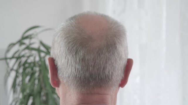 Rear view older man with bald patches on scalp, showing signs alopecia and age-related hair thinning, Anti-aging treatments for balding men, hair loss
