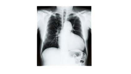 Isolated large cardiac silhouette Xray print on a white background emphasizing heart enlargement in heart failure cases for clinical and educational use.