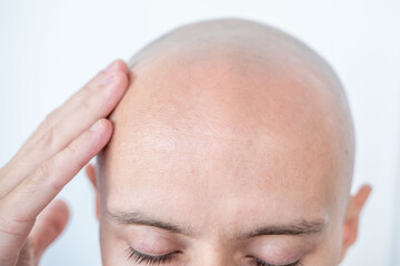 Fototapeta premium Young Bald man touching his head, eyes closed, bald patches on scalp, showing signs alopecia, healing touch, treatment hair loss, personal moment, stress relief