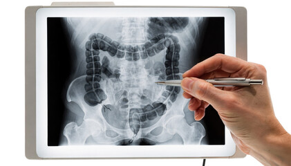 Closeup of a pen pointing at a supine abdominal xray on a lightbox highlighting areas of colonic gas pattern.