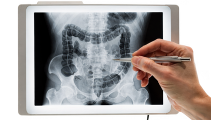 Closeup of a pen pointing at a supine abdominal xray on a lightbox highlighting areas of colonic gas pattern.