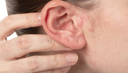 Hand gently touching irritated ear skin displaying subtle redness caused by topical allergy isolated on white background for medical use.