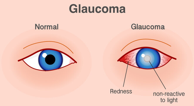 Glaucoma eye, optic nerve of the eye is damaged. Severe headache,  redness, blurred or decreased vision. Blue eye, skin color back. Illustration vector 