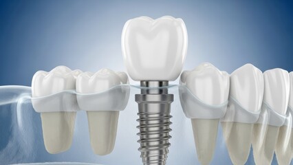Stomatology concept showing structure of metal dental implant.