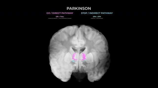 Parkinson Dopamine Loss Basal Ganglia Motor Pathways Coronal Transparent Background