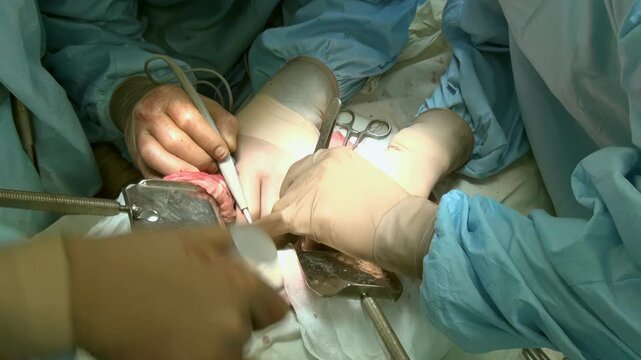 In the operating room, skilled surgeons carefully perform an intricate procedure. Precision and focus are evident in this medical environment as they work diligently on the patient.