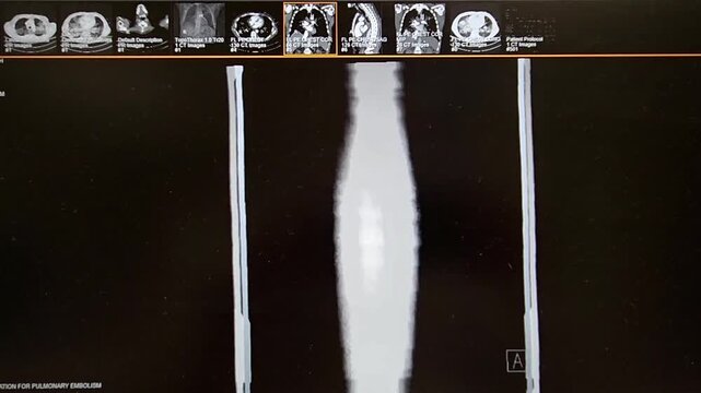 CT Chest movie - coronal plane with lung windows