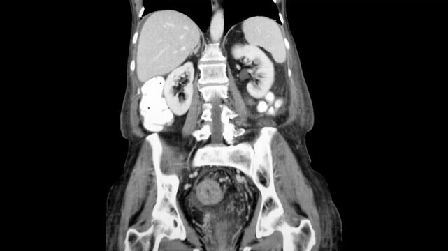 CT Abdomen - Severe C. difficile colitis with marked inflammation