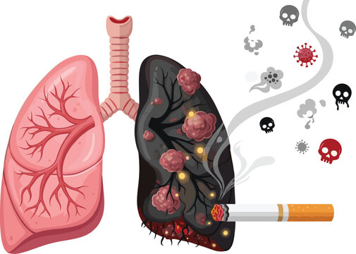 Healthy vs smoker lung comparison, cigarette damage, disease illustration, medical awareness graphic, anti-smoking visual, flat vector illustration