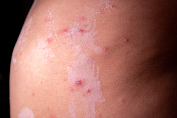 Fototapeta premium Close-up of acne on skin