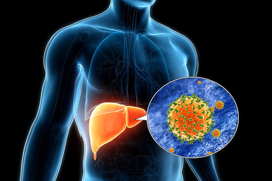 3D medical illustration of a human liver affected by hepatitis B, with detailed zoom-in of HBV virus and surface antigens. High-detail render ideal for biomedical content