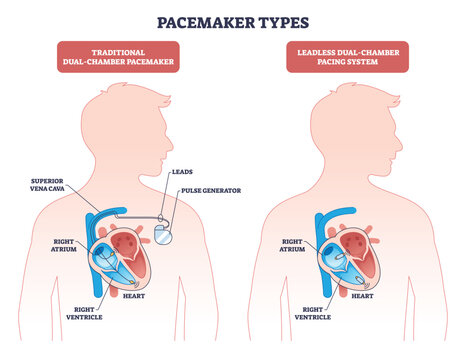 Pacemaker types overview compares traditional dual-chamber and leadless devices, highlighting heart, leads, and pulse generator placements. Outline diagram