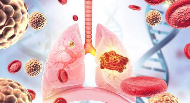Conceptual 3D Illustration of Viral-Induced Lung Cancer