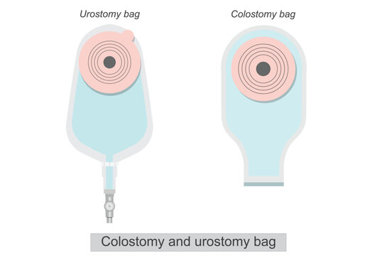 Colostomy and urostomy bag on abdomen isolated on white background.