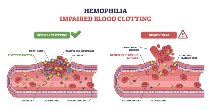 Hemophilia impaired clotting concept compares normal vs deficient repair in a blood vessel, highlighting platelets, red blood cells, and missing clotting factors causing bleeding. Outline diagram