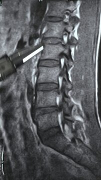 Vertical footage of x-ray with hernia in human spine. Close up view.