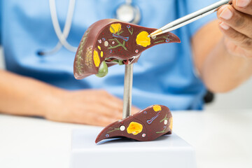 Cirrhosis, Liver cancer, fatty liver, Asian doctor with liver human model.