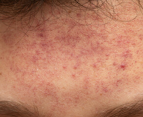 Fototapeta premium A person with a red rash on their forehead