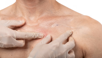 Medical professionals gloved hands tracing the subcutaneous path of shunt tubing across the clavicle area on a neutral white background highlighting tactile examination.