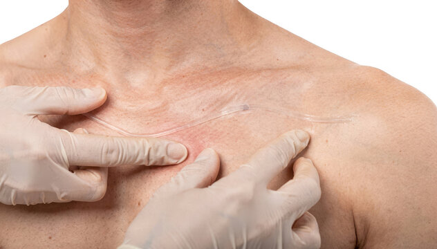 Medical professionals gloved hands tracing the subcutaneous path of shunt tubing across the clavicle area on a neutral white background highlighting tactile examination.
