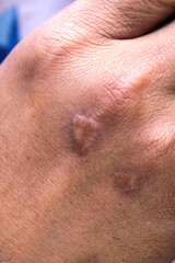Fototapeta premium Close-Up of Human Hand Showing Bruise and Skin Texture Variations