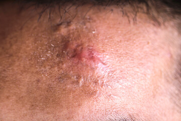 Fototapeta premium Close-Up of Skin Imperfection on Forehead with Healing Scabs