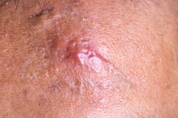 Close-Up View of Skin Lesion on Human Forehead in Natural Light