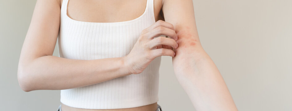 Sensitive skin allergic concept, Woman itching on her arm have a red rash from allergy symptom and from scratching.