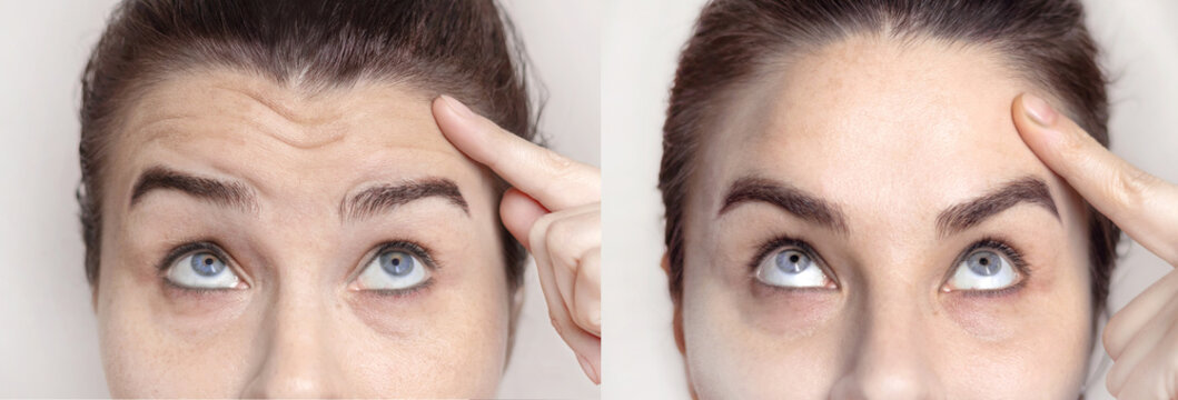 Collage with portraits Caucasian woman with wrinkles on the forehead and between her nose and portrait after visiting a beautician. Botox injections, dysport. Folds on the skin. Close up photo