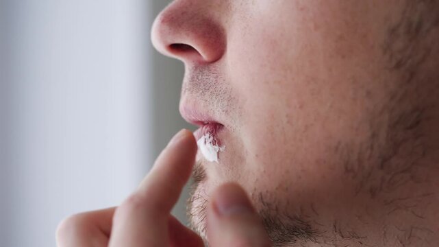 Close up shot of a man applying cream to a cold sore on his lip, caused by the herpes simplex virus. This medical condition is known for causing painful sores and requires targeted treatment