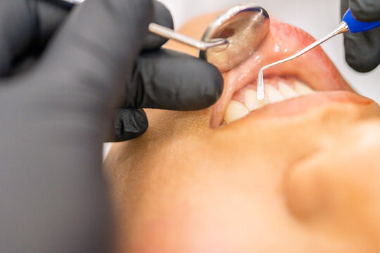 Dentist applying dental composite material on tooth