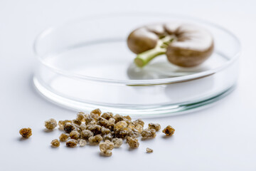Kidney stone metaphor concept shows kidney model and multiple stone samples in clear petri dish on white background symbolizing medical condition and health risk
