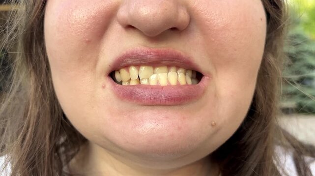 Patient with dislocated jaw and malocclusion, temporomandibular joint dysfunction. She is opening and closing mouth. 