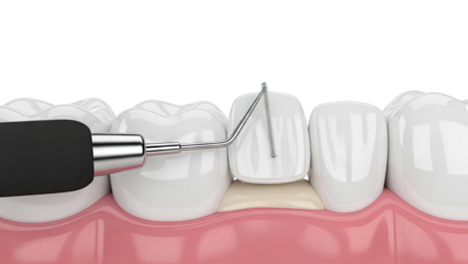 Dental probe measuring gum recession on a tooth