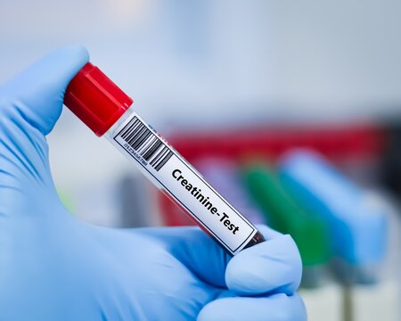 Blood sample tube for creatinine test analysis.