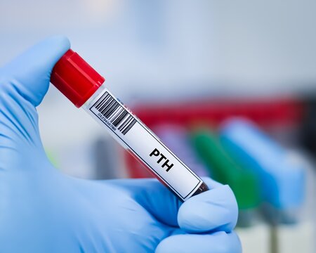 Blood sample tube for parathyroid hormone (PTH) test analysis.
