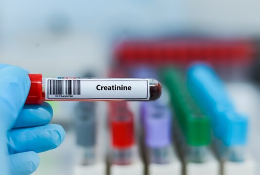 Blood sample tube for creatinine test analysis.