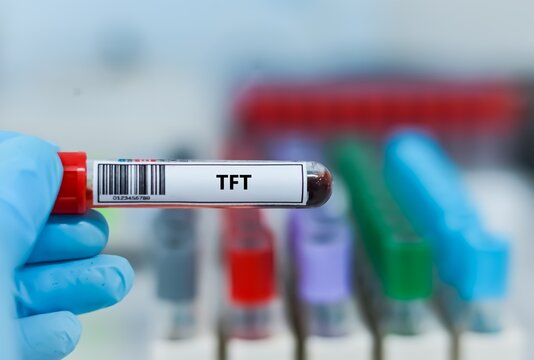 Blood sample tube for thyroid function test analysis.