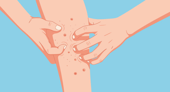 Close up view of hands scratching a red and itchy skin rash on a leg, illustrating symptoms of an allergy, eczema, or insect bite.