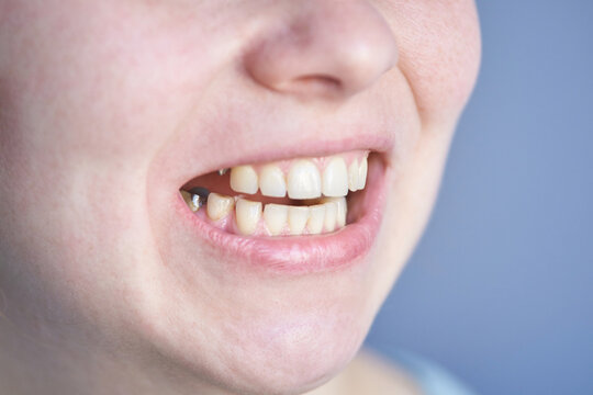 Close-up of young caucasian female smiling with missing tooth on a blue background.