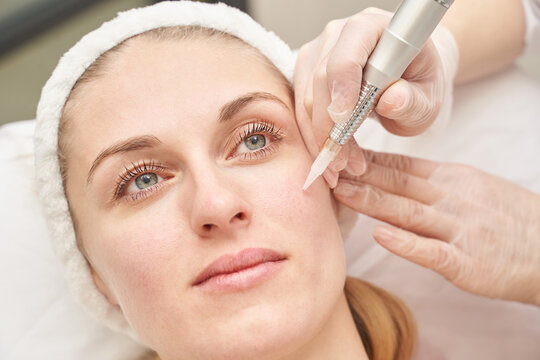 Caucasian female receiving microneedling facial treatment in spa for skin rejuvenation and beauty enhancement.
