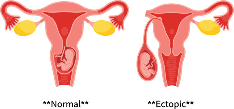 Medical vector illustration comparing a normal uterine pregnancy and an ectopic pregnancy in the fallopian tube for education.
