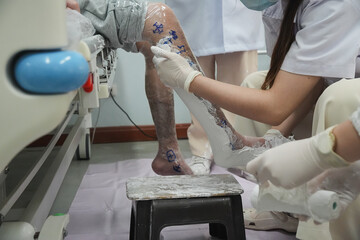 Orthotic fabrication process showing a specialist shaping a lower leg mold for a custom ankle foot orthosis (AFO). Clinical workspace scene focused on precision, care, and assistive device production.