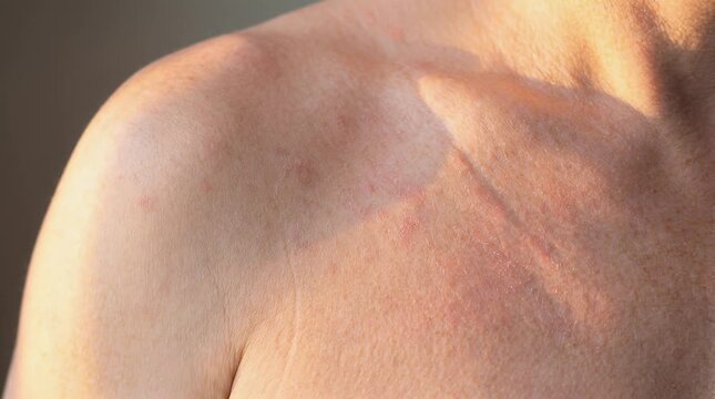 Photodermatitis Sun Sensitivity Reaction on Shoulder and Upper Chest, Mild Redness and Patchy Irritation After Sun Exposure