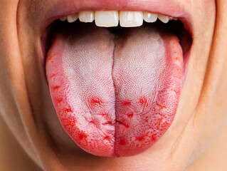 Close up of human tongue with red spots and white coating mouth oral